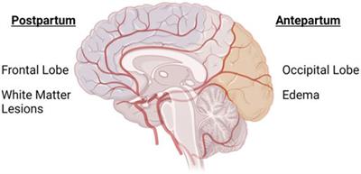 Preeclampsia history and postpartum risk of cerebrovascular disease and cognitive impairment: Potential mechanisms